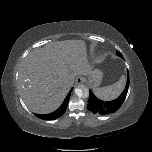 Aortic dissection - Stanford type B (Radiopaedia 88281-104910 A 81).jpg