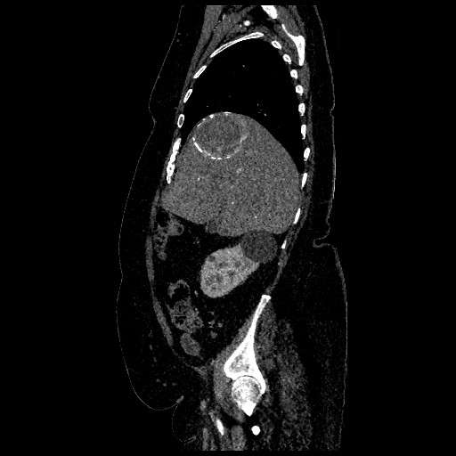 Aortic dissection - Stanford type B (Radiopaedia 88281-104910 C 16).jpg