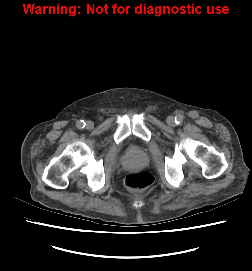 File:Aortic graft infection (Radiopaedia 44979-48907 Axial non-contrast 93).jpg