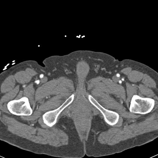 Aortic intramural hematoma (Radiopaedia 31139-31838 B 179).jpg