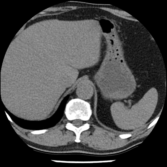 Aortic intramural hematoma (type B) (Radiopaedia 79323-92387 Axial non-contrast 50).jpg