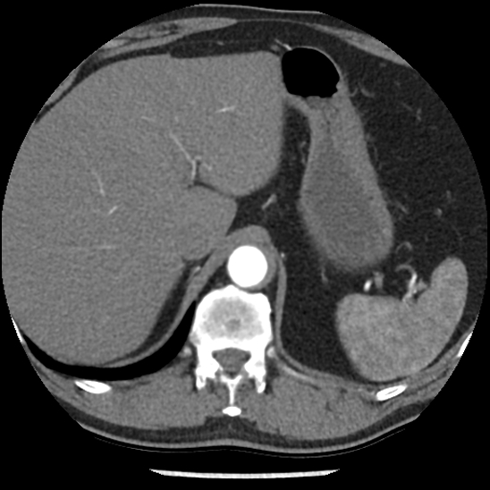 Aortic intramural hematoma (type B) (Radiopaedia 79323-92387 B 53).jpg