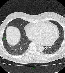 File:Aortic valve endocarditis (Radiopaedia 87209-103485 Axial lung window 69).jpg