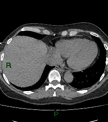 File:Aortic valve endocarditis (Radiopaedia 87209-103485 Axial non-contrast 78).jpg