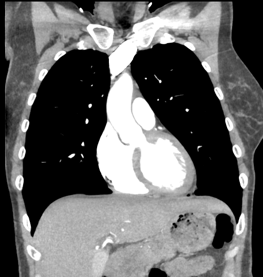Aortic valve non-coronary cusp thrombus (Radiopaedia 55661-62189 C 28).png