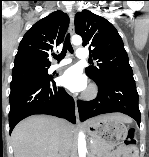 File:Aortic valve non-coronary cusp thrombus (Radiopaedia 55661-62189 C 42).png