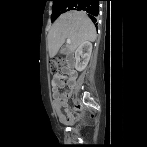 File:Aorto-duodenal fistula (Radiopaedia 25668-25850 C+ arterial phase 1).jpg