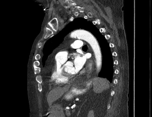 Aortoesophageal fistula with endovascular repair (Radiopaedia 73781-84592 Sagittal C+ CTPA 121).jpg