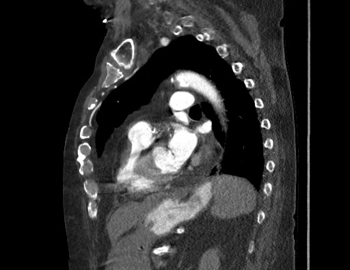 Aortoesophageal fistula with endovascular repair (Radiopaedia 73781-84592 Sagittal C+ CTPA 124).jpg