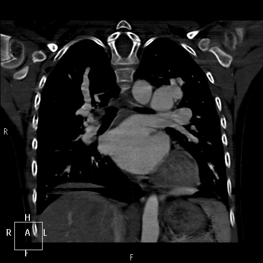 File:Aortopulmonary septal defect (Radiopaedia 41990-45013 Coronal C+ CTPA 40).jpg