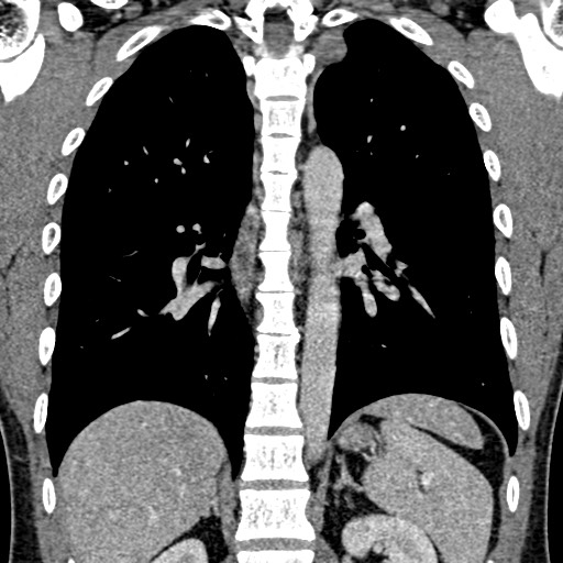 Apical lung mass mimic - neurogenic tumor (Radiopaedia 59918-67521 B 73).jpg