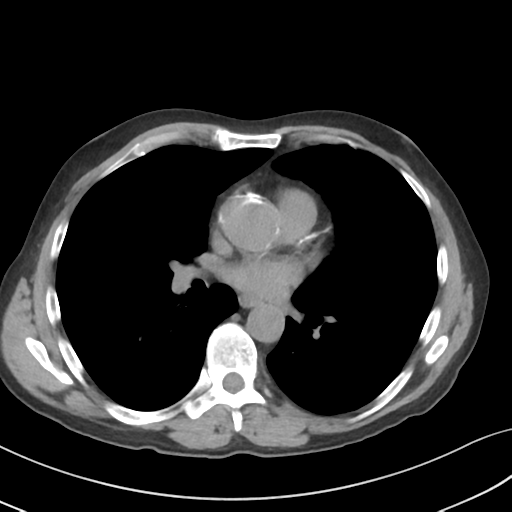 Apical pulmonary metastasis (Radiopaedia 46338-50754 B 35).png