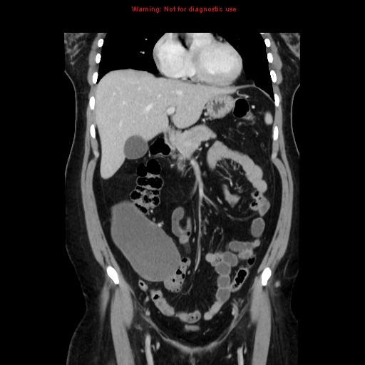 Appendiceal mucinous cystadenoma (Radiopaedia 8263-9111 B 27).jpg