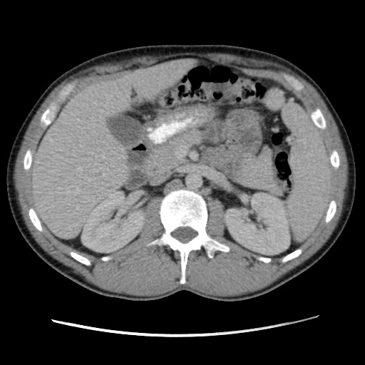 Appendicitis complicated by post-operative collection (Radiopaedia 35595-37114 A 30).jpg