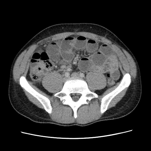 File:Appendicitis complicated by post-operative collection (Radiopaedia 35595-37114 A 56).jpg