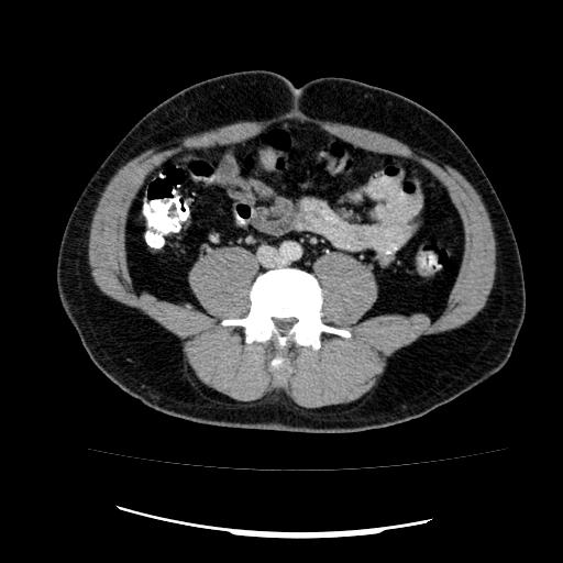 File:Appendicitis with diverticulosis (Radiopaedia 47693-52383 Axial C+ 90).jpg