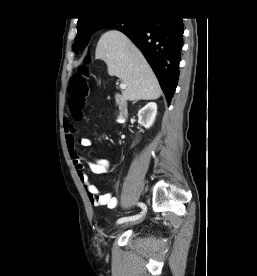 Appendicitis with localized perforation and abscess formation (Radiopaedia 49035-54130 C 22).jpg