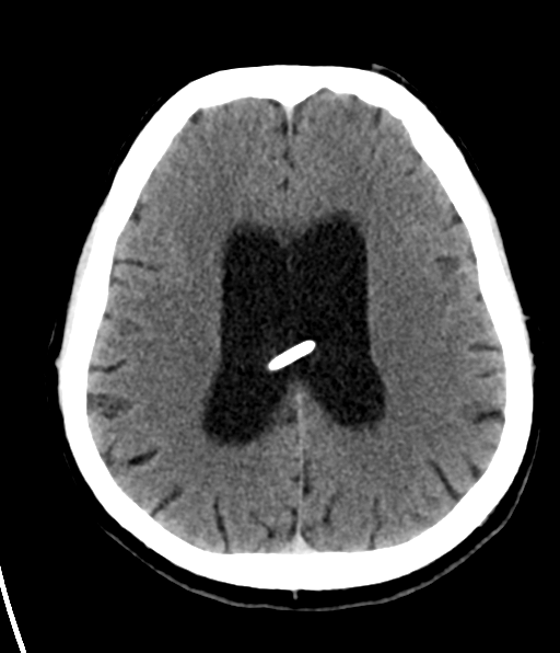 File:Aqueduct stenosis with corpus callosum hypoattenuation post shunting (Radiopaedia 37212-38973 Axial non-contrast 21).png