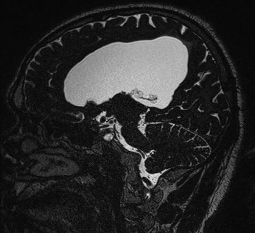 File:Aqueduct stenosis with spontaneous 3rd ventriculostomy (Radiopaedia 74381-85267 A 56).jpg