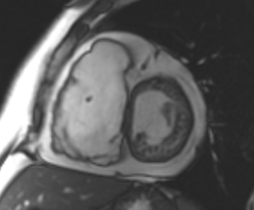 File:Arrhythmogenic right ventricular cardiomyopathy (Radiopaedia 69431-79307 Short axis cine 157).jpg