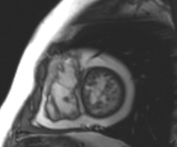 Arrhythmogenic right ventricular cardiomyopathy (Radiopaedia 69431-79307 Short axis cine 52).jpg