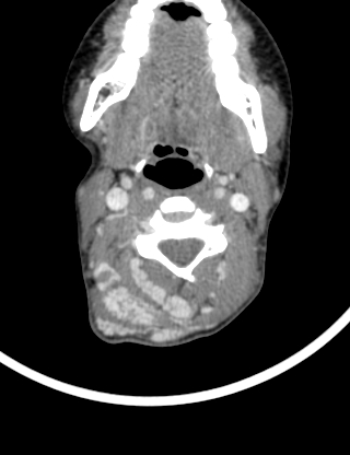 Arteriovenous malformation of the neck (Radiopaedia 53935-60062 B 20).jpg
