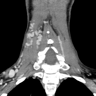 Arteriovenous malformation of the neck (Radiopaedia 53935-60062 D 29).jpg