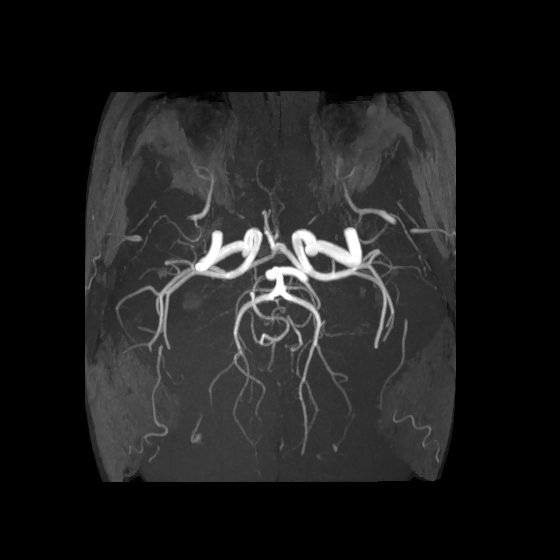 Artery of Percheron infarct (Radiopaedia 40966-43676 F 40).jpg