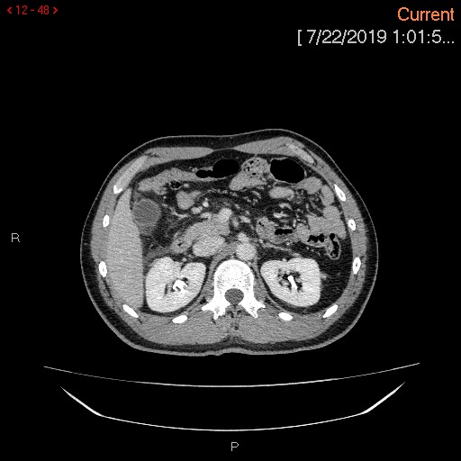File:Ascending colonic diverticulum mimicking acute appendicitis (Radiopaedia 69943-80198 A 48).jpg