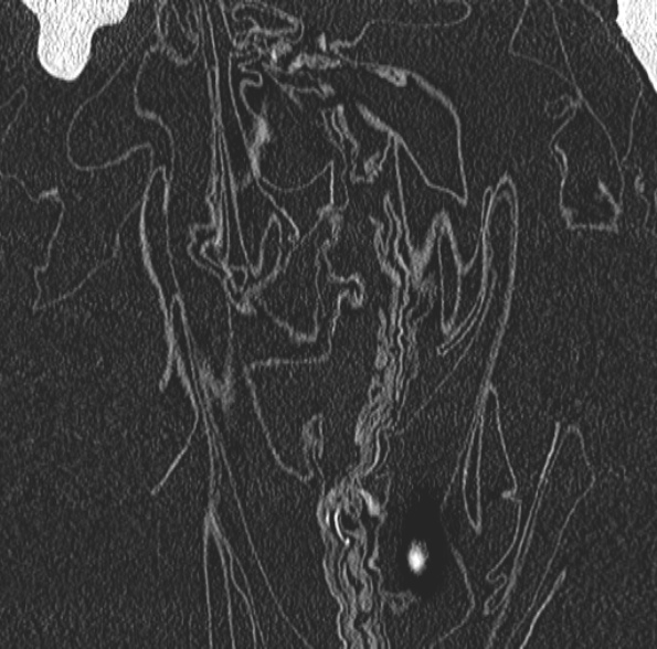 Aspergilloma- with Monod sign (Radiopaedia 44737-48532 Coronal lung window 93).jpg