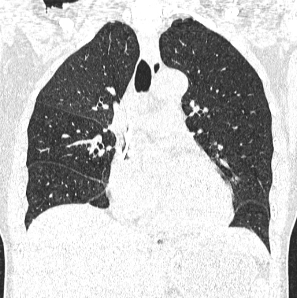 File:Aspergilloma (Radiopaedia 26223-26347 Coronal lung window 23).jpg