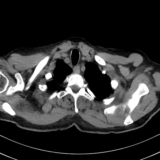 File:Aspergilloma on background pulmonary fibrosis (Radiopaedia 60942-68757 Axial non-contrast 7).jpg