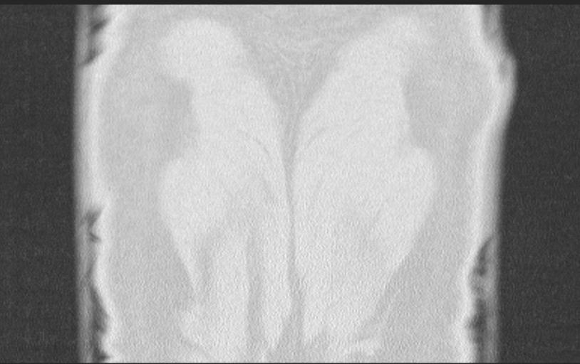 Aspirated tooth (Radiopaedia 28584-28844 Axial lung window 94).jpg