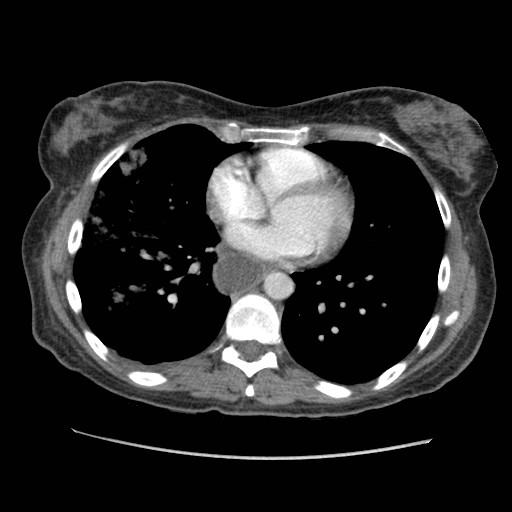 File:Aspiration pneumonia secondary to laparoscopic banding (Radiopaedia 18345-18183 A 32).jpg