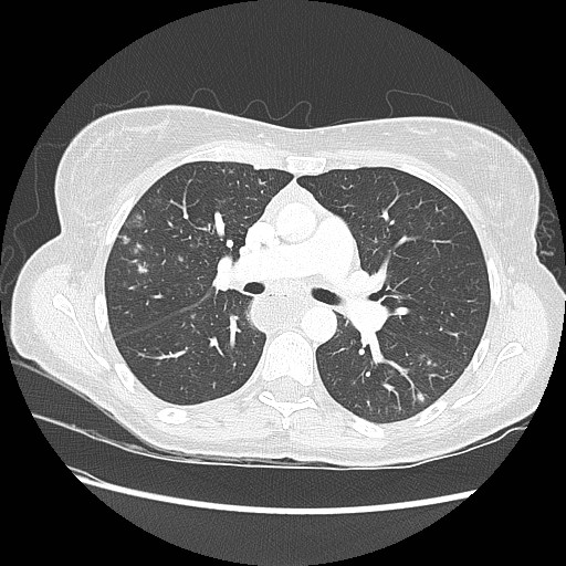 Aspiration pneumonia secondary to laparoscopic banding (Radiopaedia 18345-18183 lung window 46).jpg