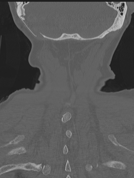 Atlanto-axial subluxation (Radiopaedia 36610-38176 Coronal bone window 46).png