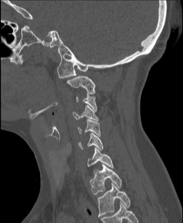 Atlanto-occipital assimilation with basilar invagination (Radiopaedia 70122-80188 Sagittal bone window 110).jpg