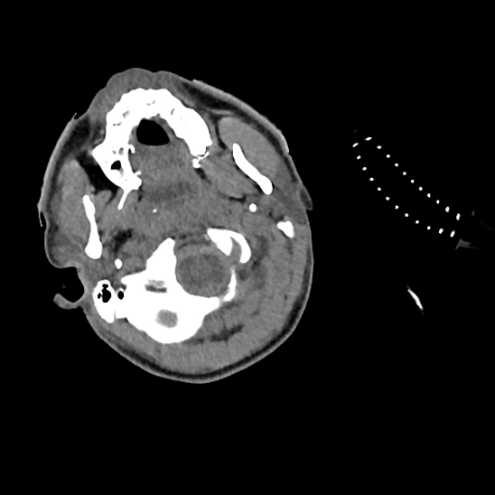 File:Atlanto-occipital dissociation (Traynelis type 1), C2 teardrop fracture, C6-7 facet joint dislocation (Radiopaedia 87655-104061 Axial non-contrast 8).jpg