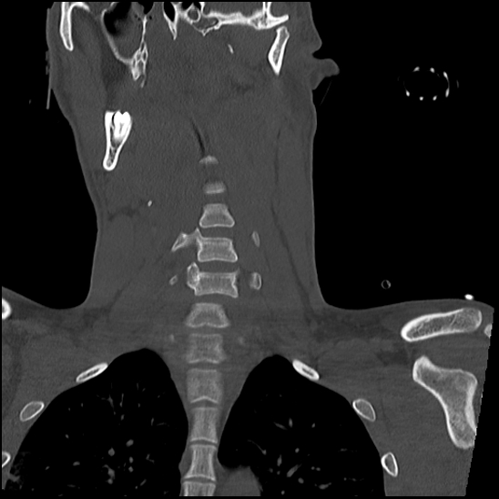 Atlanto-occipital dissociation (Traynelis type 1), C2 teardrop fracture, C6-7 facet joint dislocation (Radiopaedia 87655-104061 Coronal bone window 32).jpg