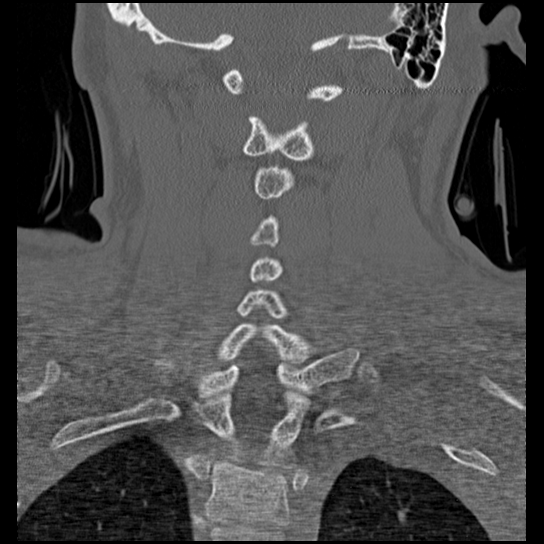 Atlanto-occipital dissociation injury (Radiopaedia 29274-29698 Coronal bone window 16).png