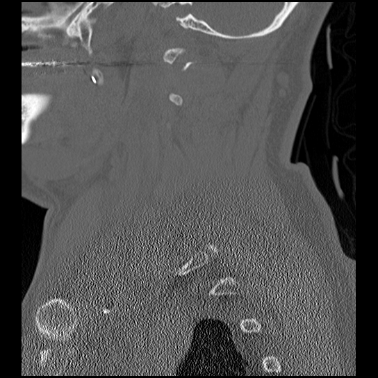Atlanto-occipital dissociation injury (Radiopaedia 29274-29698 Sagittal bone window 14).png