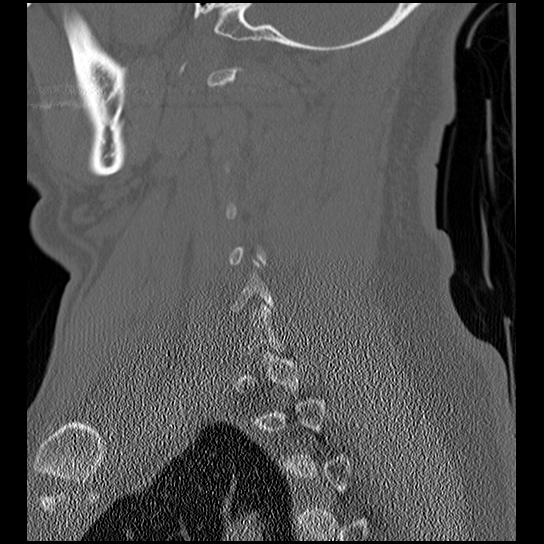 Atlanto-occipital dissociation injury (Radiopaedia 29274-29698 Sagittal bone window 44).png