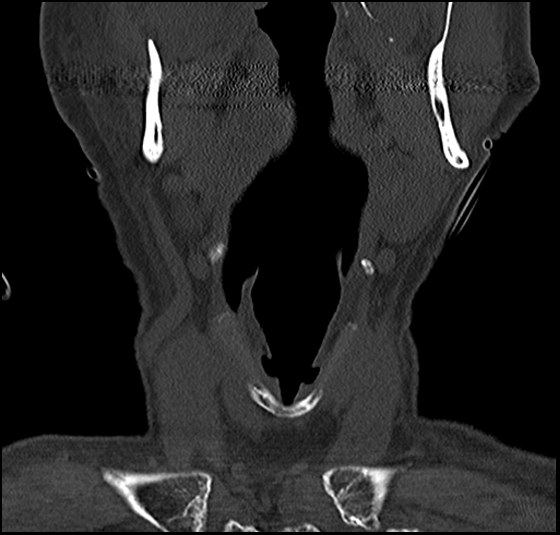 File:Atlas (type 3b subtype 1) and axis (Anderson and D'Alonzo type 3, Roy-Camille type 2) fractures (Radiopaedia 88043-104607 Coronal bone window 8).jpg