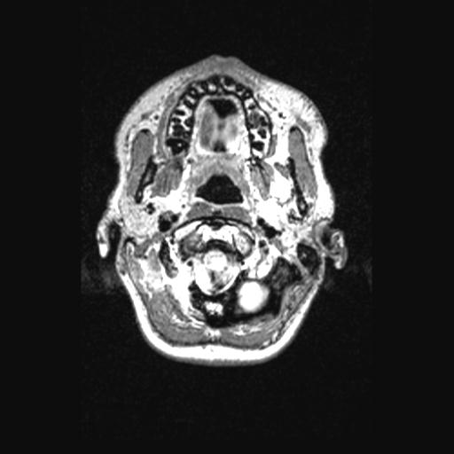 Atretic encephalocoele with inferior vermis hypoplasia (Radiopaedia 30443-31108 Axial 18).jpg