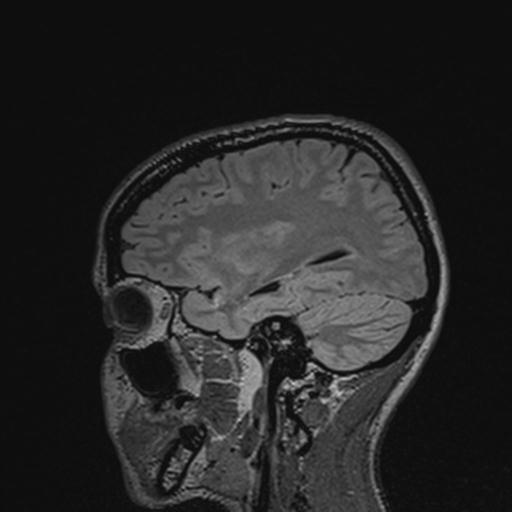 Atretic encephalocoele with inferior vermis hypoplasia (Radiopaedia 30443-31108 Sagittal FLAIR 112).jpg