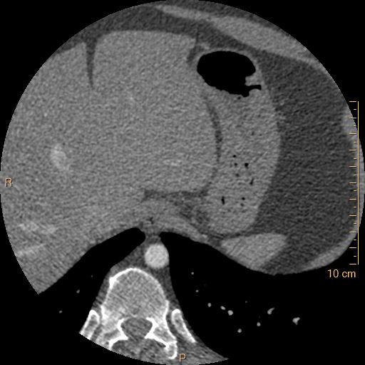File:Atrial septal defect (upper sinus venosus type) with partial anomalous pulmonary venous return into superior vena cava (Radiopaedia 73228-83961 A 285).jpg