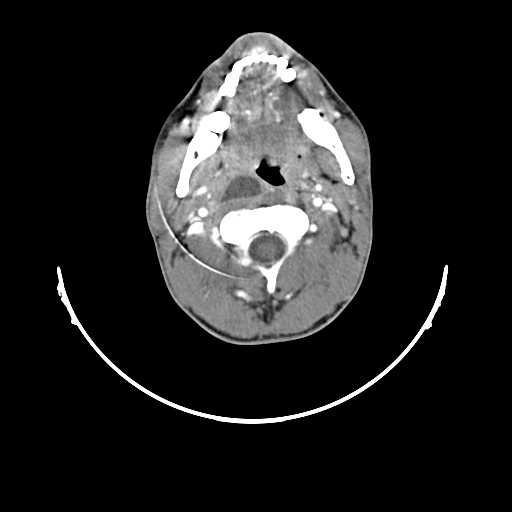 File:Atypical 2nd branchial cleft cyst (type IV) - infected (Radiopaedia 20986-20924 A 8).jpg