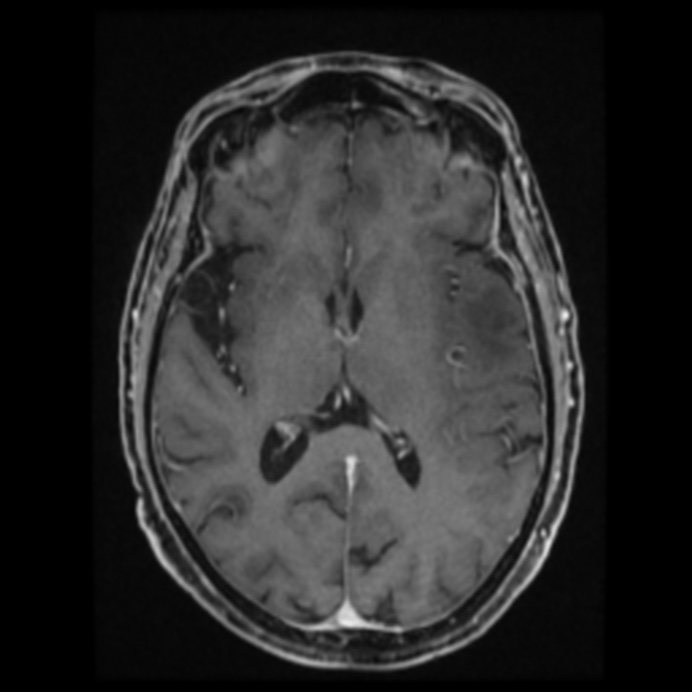 Atypical meningioma (Radiopaedia 45535-49629 Axial T1 C+ 39).jpg