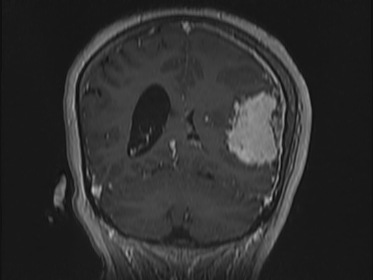 Atypical meningioma (Radiopaedia 62985-71406 Coronal T1 C+ 90).jpg