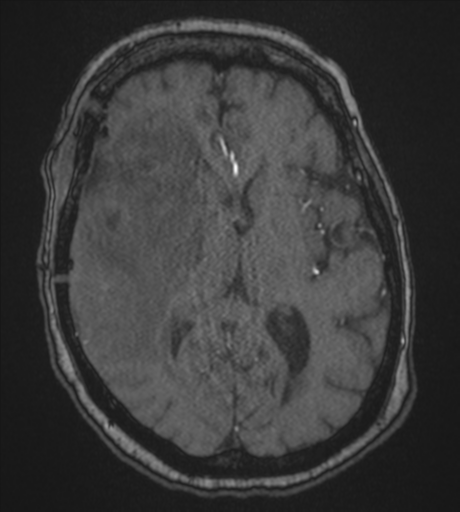 Atypical meningioma (WHO Grade II) (Radiopaedia 54742-60981 Axial MRA 52).png